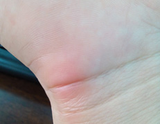 这样的肿块千万不要按摩 